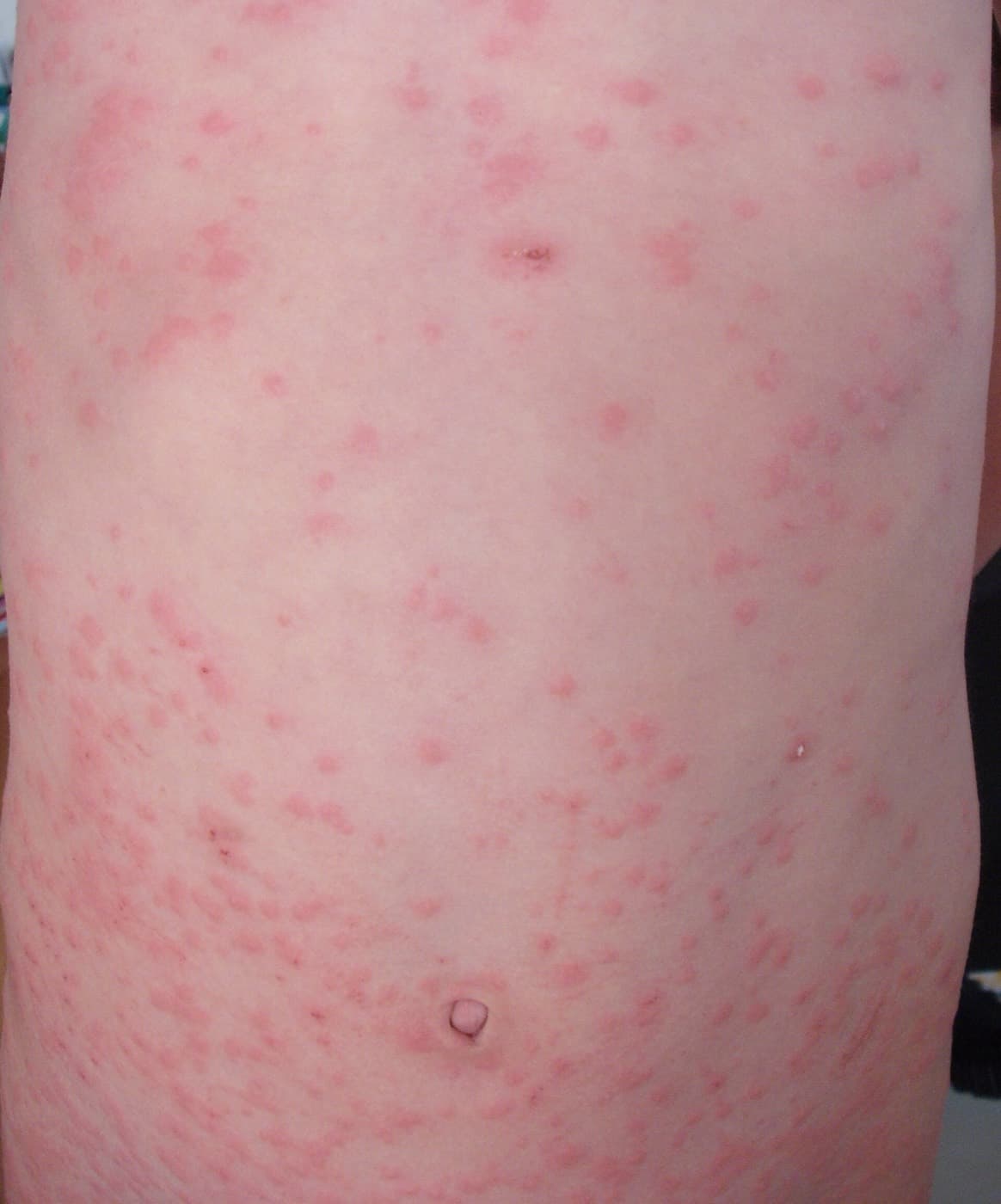 Hautausschlag (Raupendermatitis) nach Kontakt mit Brennhaaren